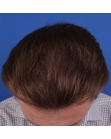 After Hair Transplant&nbsp;2 Sessions (Areas)